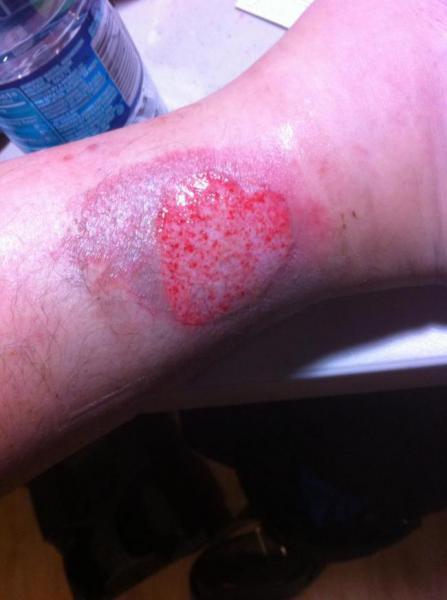 third degree side pipe burn