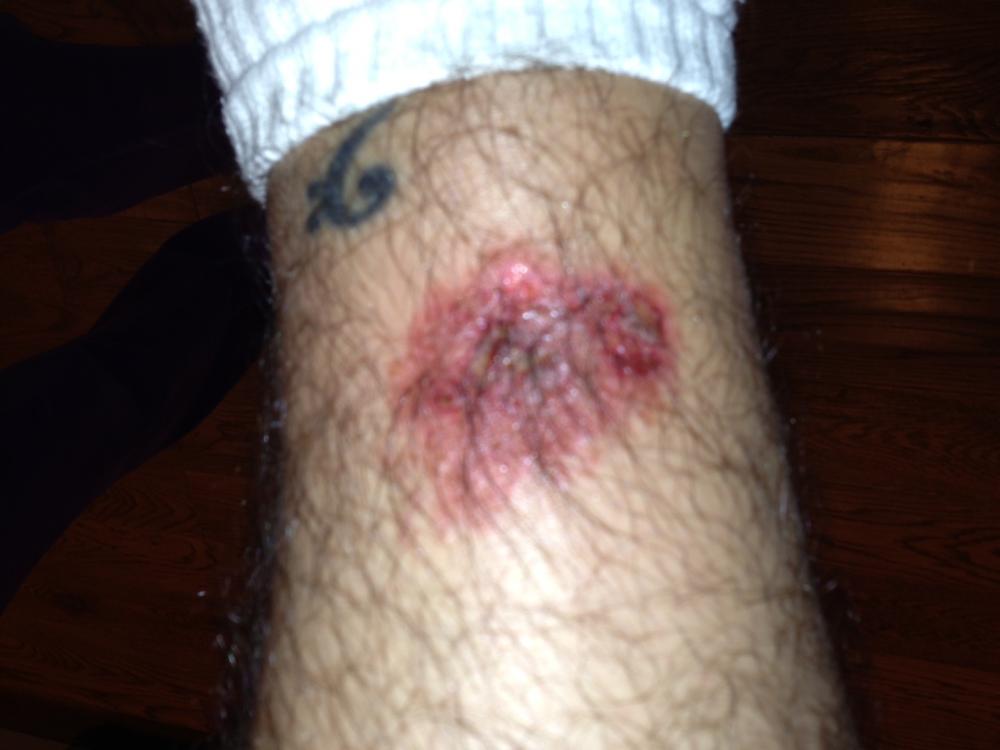 5 years, 3 cobras and 8k miles and THEN I get my first snake bite